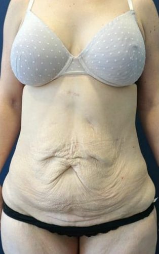 Body Contouring Plastic Surgery