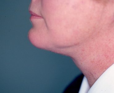 4 Months After Chin Liposuction