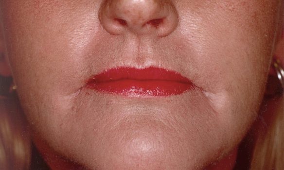 (Image 6) 6 Months AFTER Laser Resurfacing of Upper Lip & Chin (1)