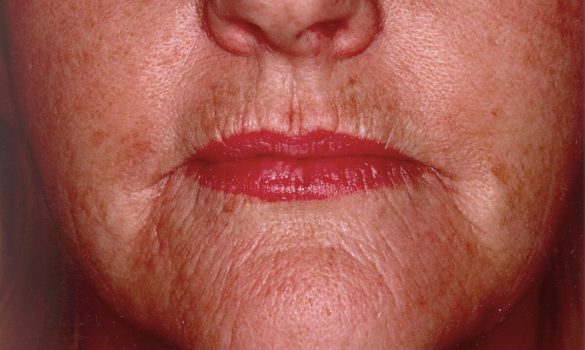 (Image 6) 6 Months AFTER Laser Resurfacing of Upper Lip & Chin (2)