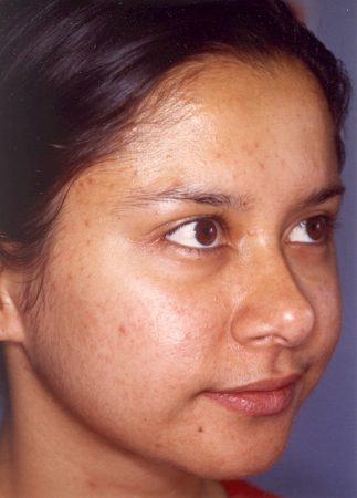 Acne Treatment Sydney