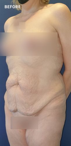 Before Corset Abdominoplasty Sydney