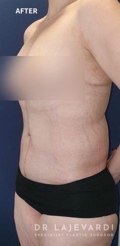 8 Months After Corset Abdominoplasty Sydney