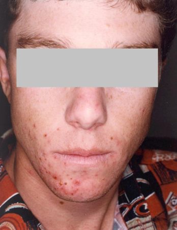 Before Acne Treatment