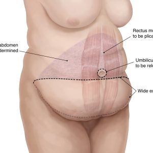 Full Tummy Tuck Surgery Technique