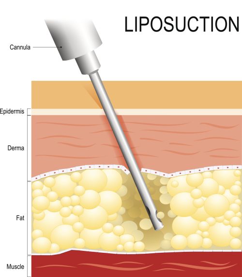 Liposuction. fat modeling. Cannula into the fat layer beneath skin.