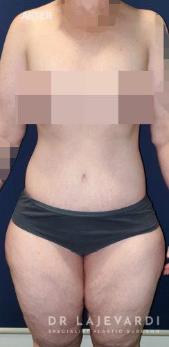 7 Months After Body Lift Sydney