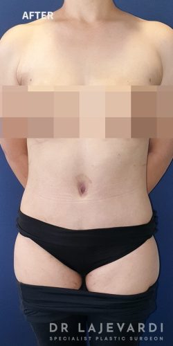 3 Months After Body Lift Surgery Sydney