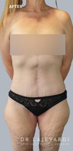 4 Months After Corset Tummy Tuck Surgery