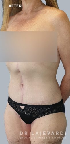 4 Months After Corset Tummy Tuck Surgery