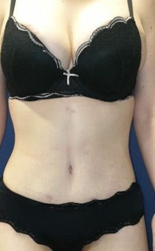 6 Months After Body Contouring Plastic Surgery